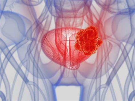 Tratamento Para C Ncer De Bexiga Tudo O Que Voc Precisa Saber Sobre