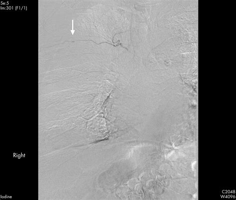 Intercostal aneurysm causing massive haemothorax | BMJ Case Reports