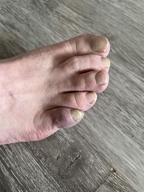 FIL (60m) pinky toes (both feet) look like this. He says they’re very