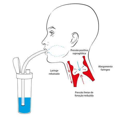 Garrafa Pr Fono Etvso Exerc Cios Do Trato Vocal Semioclu Do Pr Fono