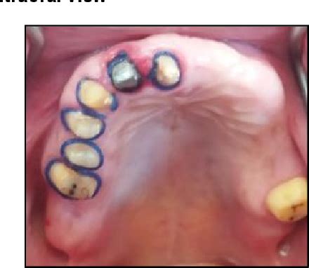 Figure From Maxillary Prosthodontic Rehabilitation With Fixed