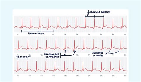 Junctional Rhythm Vs Sinus Rhythm On Your Watch Ecg Qaly