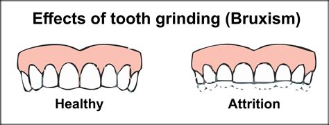 Bruxism: Causes and Treatments
