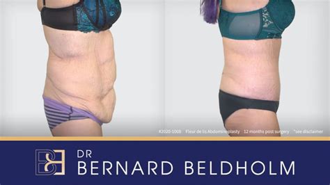 Fleur-de-Lis Abdominoplasty Post Weight Loss Before & After Results