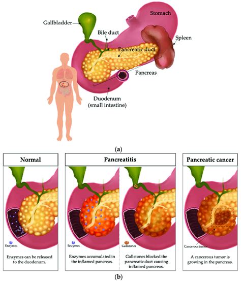 Illustration of the pancreas. (a) Location of the pancreas in the human ...