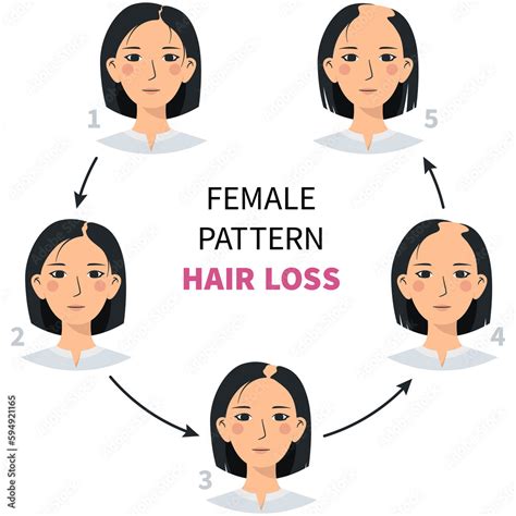 hair loss stages female androgenetic alopecia steps  baldness flat