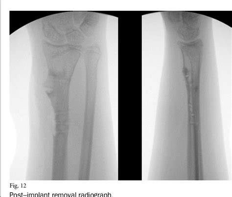 Figure 1 From Corrective Osteotomy And Physeal Bar Resection For Distal