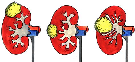 Renal Cell Carcinoma Clinical Surgery Intechopen