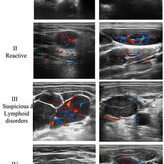 The ultrasound morphologic characteristics of cervical adenopathy. | Download Scientific Diagram