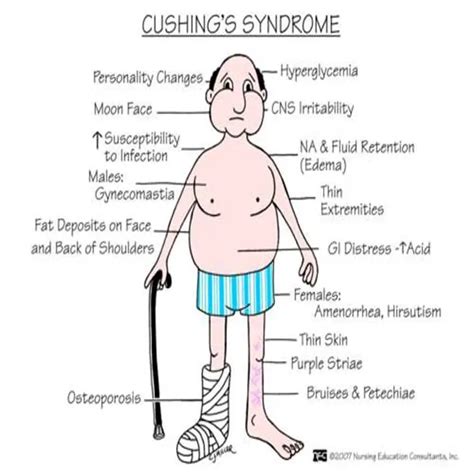What Is Cushing Syndrome? - Postme cloud
