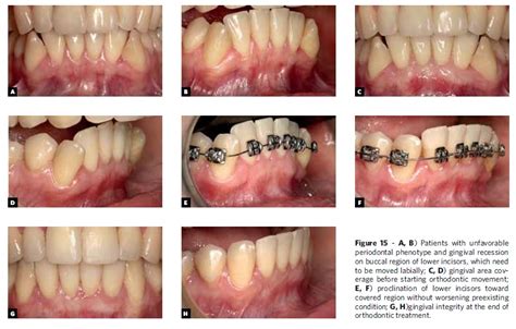 Scielo Brazil Gingival Esthetics An Orthodontic And Periodontal