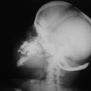 Lateral skull showing open fontanelles with nonaerated paranasal sinus... | Download Scientific ...