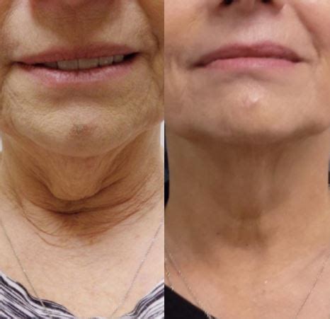 Can I Reduce My Double Chin Without Surgery Rancho Santa Margarita