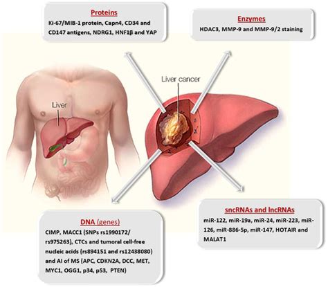 Molecular Clues For Prediction Of Hepatocellular Carcinoma Recurrence After Liver