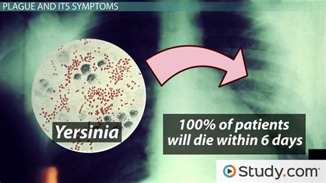 Plague | Types, Symptoms & Treatment - Video & Lesson Transcript ...