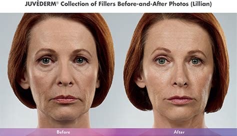 Juvéderm Dermal Filler Products Aesthetica Skin Health Center In Wi