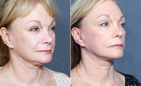 Dr Roark Facelift, Neck Lift and Upper Eyelids - La Jolla Cosmetic ...