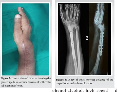 Figure From Recurrence Of Gctb Of Wrist In An Autografted Non