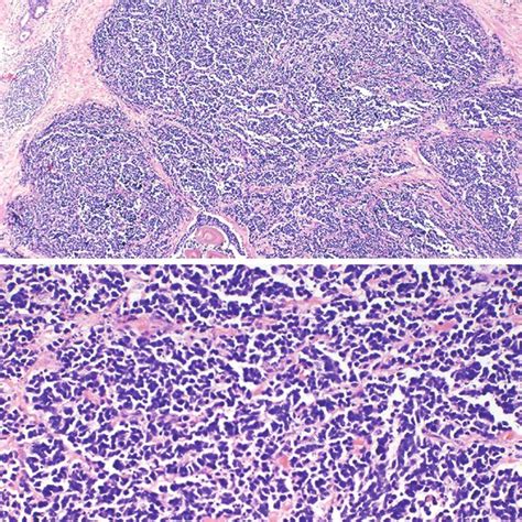 Prostatic Small Cell Carcinoma Hematoxylin And Eosin Stain A Download Scientific Diagram