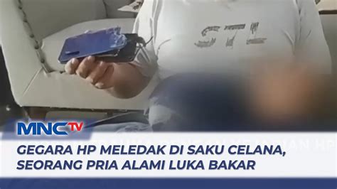 Seorang Pria Di Sumut Menderita Luka Bakar Akibat Ponsel Meledak Di