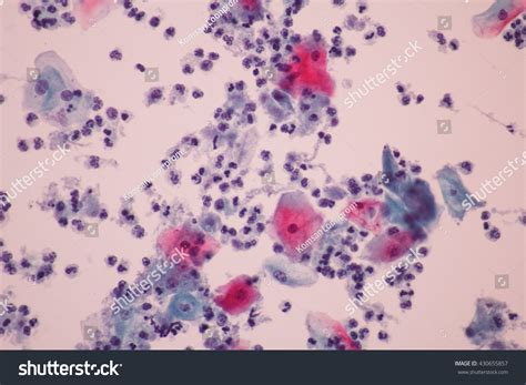 Trichomonas Pap Smear Cytology View Microscopicmedical Foto Stock 430655857 Shutterstock