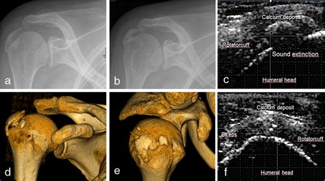 Imaging Of Calcium Deposit In Calcifying Tendinitis With Conventional