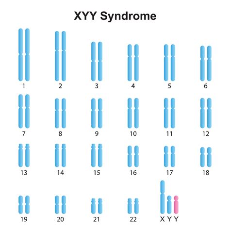 47 Xyy Jacobs Syndrome