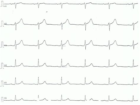 pericarditis myocarditis perimyocarditis ecg criteria treatment