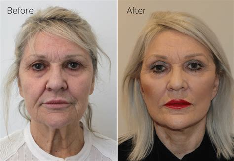Facelift & Neck Lift Performed Under Sedation Anaesthesia
