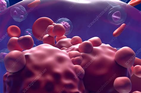 Acute Lymphoblastic Leukemia Illustration Stock Image F0385779