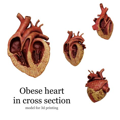 Stl File Anatomical Human Obese Heart In Cross Section 🫀・3d Printable