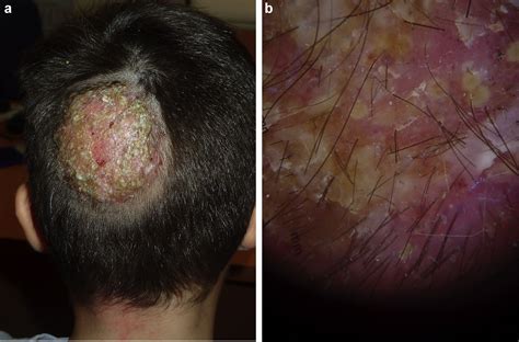 Kerion Celsi caused by Trichophyton tonsurans with dermatophytid ...
