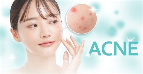 acne treatment  kl penang  klinik signature