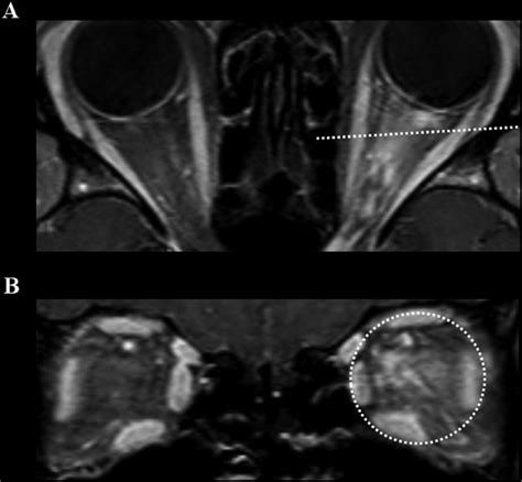 Differential Diagnosis Of Neuromyelitis Optica Spectrum Disorders Sung Min Kim Seong Joon Kim