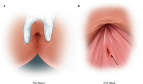 Anal Fissure Treatment In Mumbai Dr Chintamani Godbole
