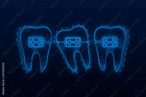 Correction Of Teeth With Orthodontic Braces Stages Of Teeth Alignment