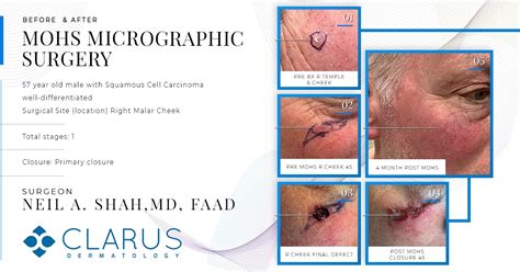 Mohs Micrographic Surgery Mole Removal Dermatologistclarus Dermatology