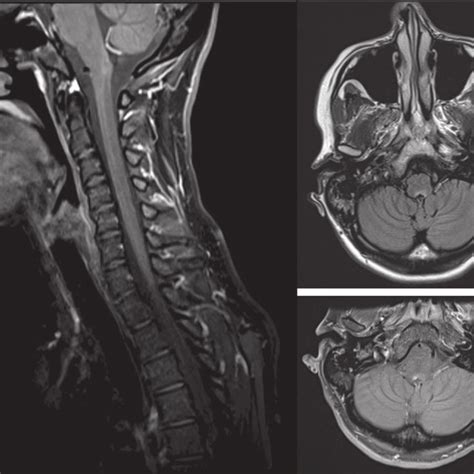 (a) MRI Spine, T1 Sagittal and (b) T1 Axial with gadolinium ...