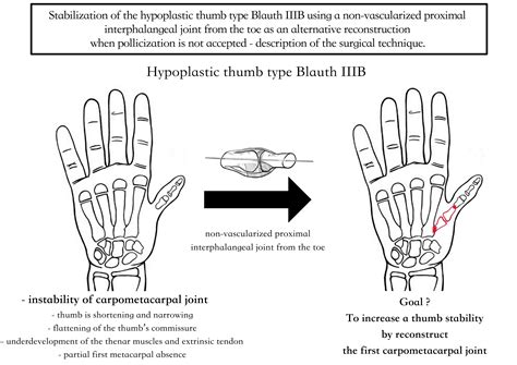 Interphalangeal Joint