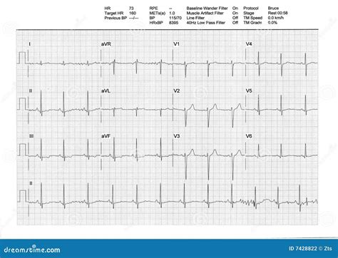 EKG Or ECG Result From A Treadmill Stress Test Stock Photo - Image: 7428822