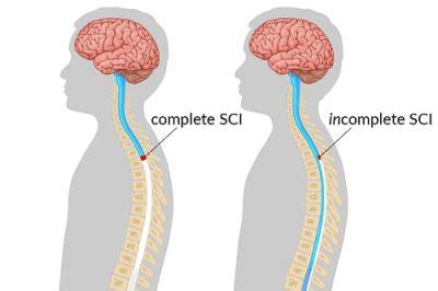 Types Of Spinal Cord Injury Complete Vs Incomplete Levels Asia