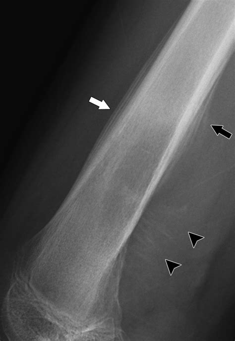 Radiography in the Initial Diagnosis of Primary Bone Tumors | AJR