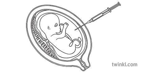 Amniocentese Diagrama Sexo Genético Genes Gênero Ciência Secundário Bw Rgb