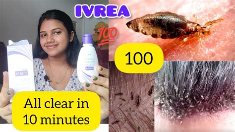 How To Use IVREA Shampooall Lice Clear In Just 10 Minutes Liceremoval