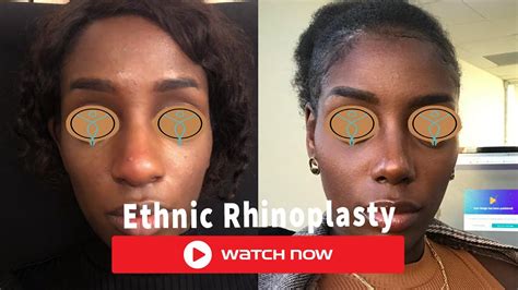 Dr Bora Ok Md Ethnic Rhinoplasty Natural Nose Job Surgery