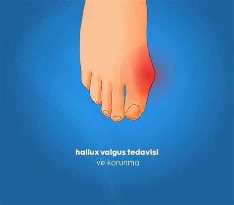 Halluks Valgus Kemik K Nt L Ortopedik Ayakkab