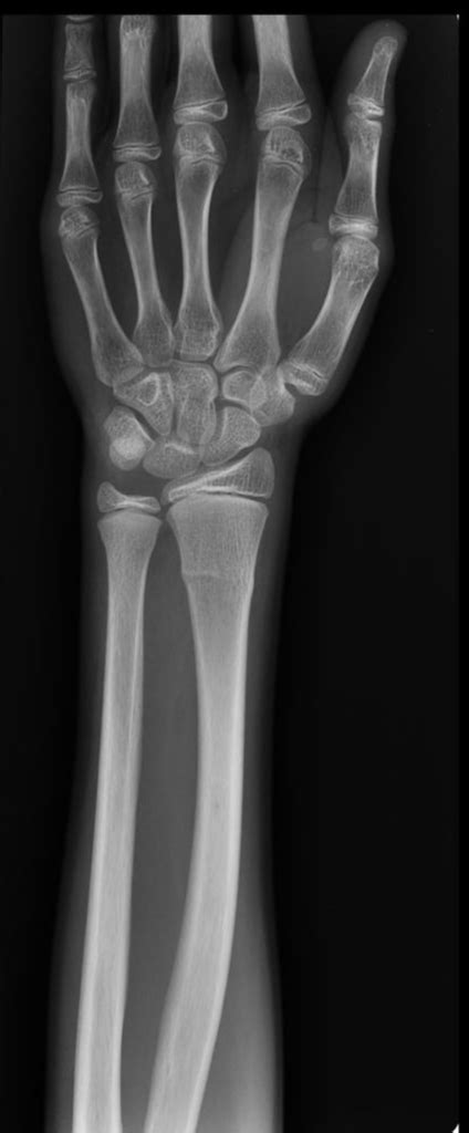Radiopaedia Case Incomplete Radial Fracture Id 10733 Study 11194 Nc