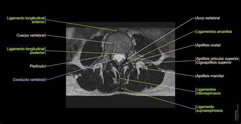 Columna Lumbar Irm Anatomía Normal E Anatomy