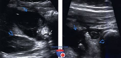 Методы обследования аппендицита
