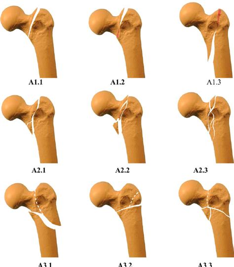 The Ao Ota Classification Of The Extracapsular Proximal Femur Fractures Download Scientific